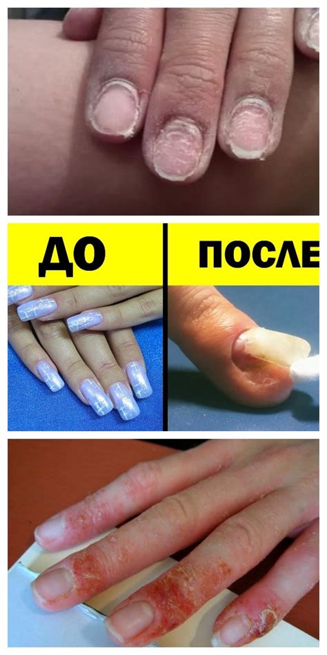 Ужасные последствия применения ГЕЛЬ-ЛАКА!