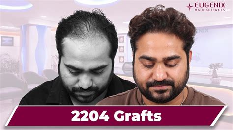 Natural Hair Lines Hair Transplant From Balding Worries To Ultimate