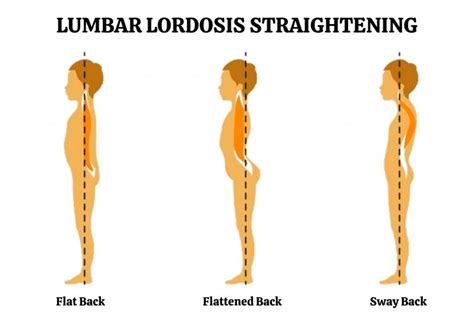 Loss Of Lumbar Lordosis Exercises