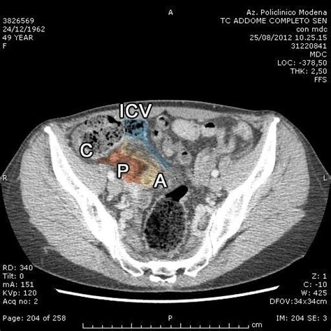 Ct Scan With Contrast Medium Showing A Bent Phlegmonous Appendix With A