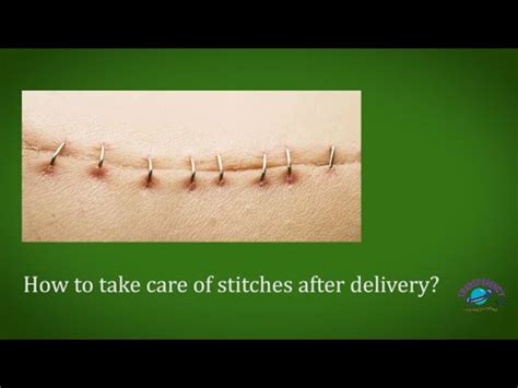 How To Take Care Of Stitches After Delivery Medical Advise On