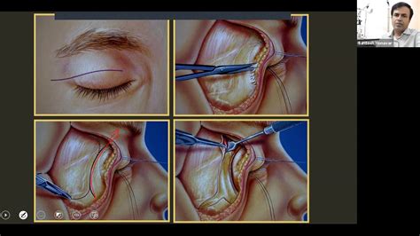 Orbitotomy Techniques Deep Obritotomyand Exenteration By Dr Santosh G