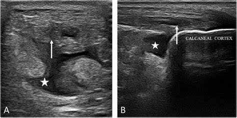 Hrus Of Chronic Calcific Tendinosis Of Achilles Tendon A Download Scientific Diagram