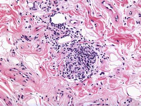 Actinic Cheilitis Histology