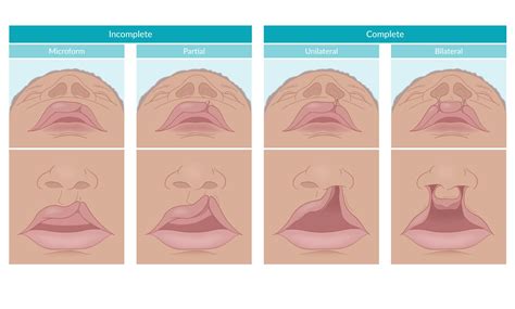 Fun Facts About Cleft Lip Palate Infoupdate Org