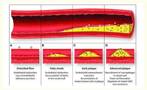 Potential Contribution Of Endmt To Atherosclerosis Progression At Download Scientific Diagram