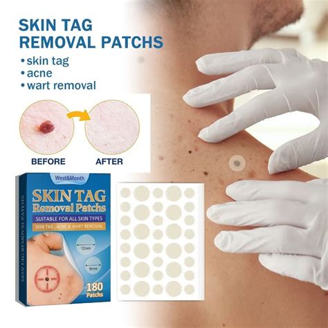 3 PACK 540PCS Warts Remover Patch Skin Tags Pimple Treatments Cream