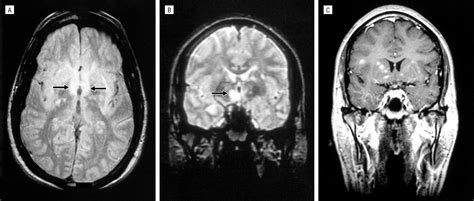 Acquired Sexual Paraphilia In Patients With Multiple Sclerosis Demyelinating Disorders Jama