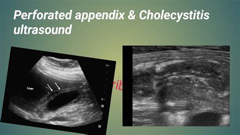 Perforated Appendix Ultrasound Cholecystitis On Ultrasound Youtube 123