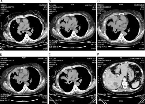 Pdf Treating Pulmonary Blastoma With Egfr Tyrosine Kinase Inhibitor A