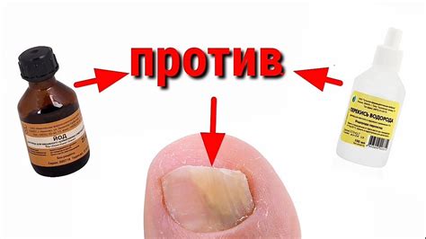 Грибок ногтей лечение . в 2024 г | Лечение ног, Лечение, Лечение ногтей