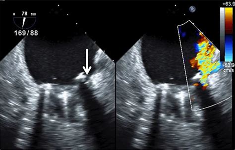 Infective Endocarditis Echo