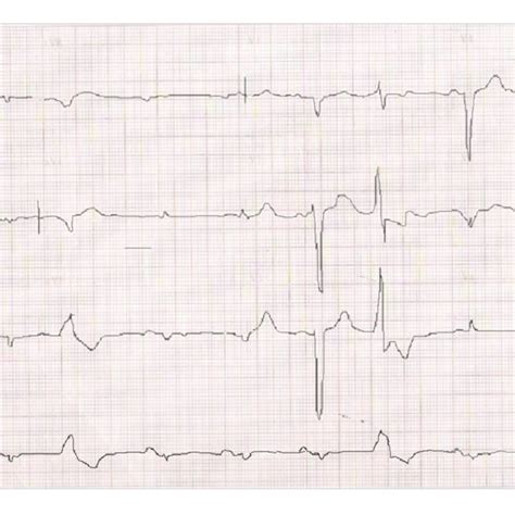 Ecg Sinus Bradycardia Intraventricular Conduction Disturbance Of The