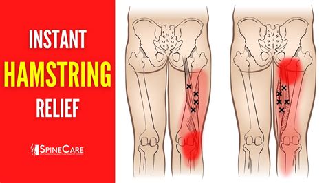 How To Fix Hamstring Pain FOR GOOD YouTube