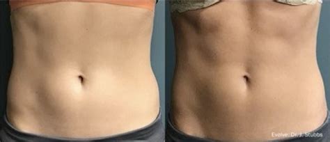 Body Contouring Columbus Ohio Reverse Aesthetics