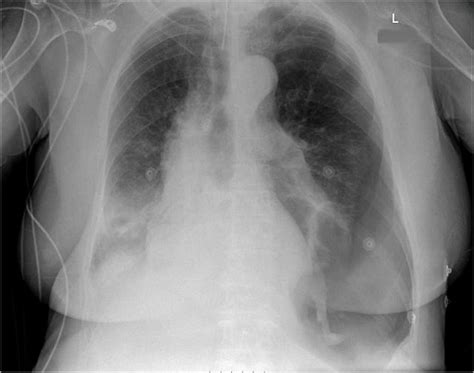 Apical Pneumothorax Chest X Ray