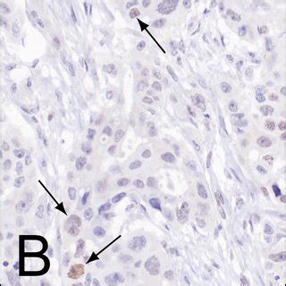 Patterns Of Pten Expression And Scoring System Employed In The Present