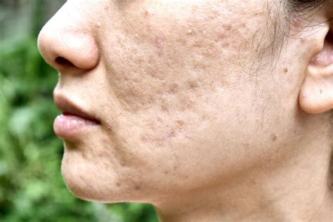 Acne em adultos saiba como tratar 11 01 2024 Equilíbrio Folha