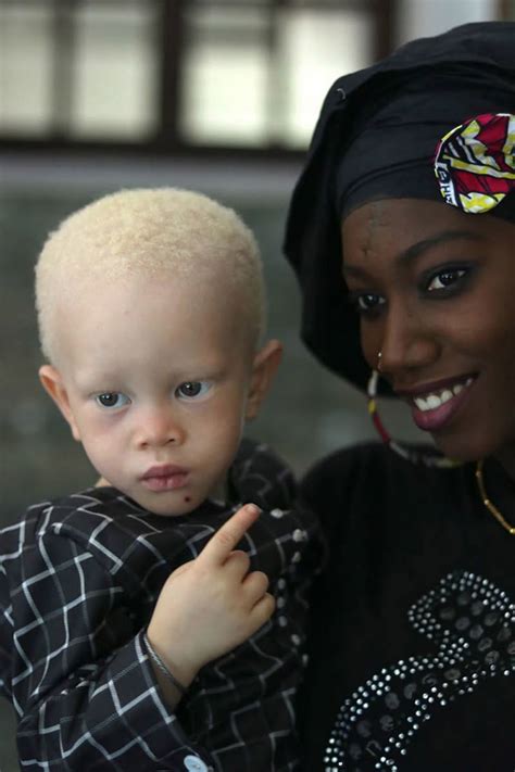 Pin on Albino people
