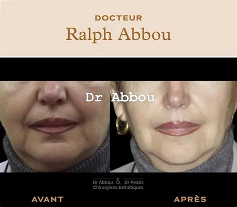 Supprimer les rides autour des lèvres injection botox levre Dr ABBOU