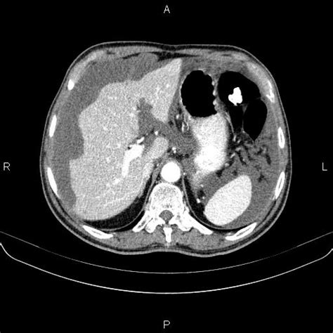 Pseudomyxoma Peritonei Image