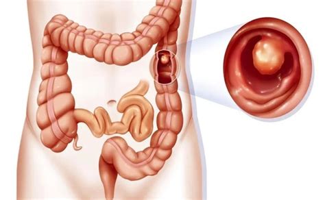 Intussusception Sut Hospital