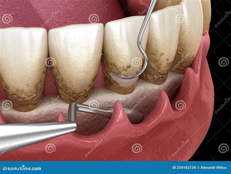 Open Curettage Scaling And Root Planing Conventional Periodontal