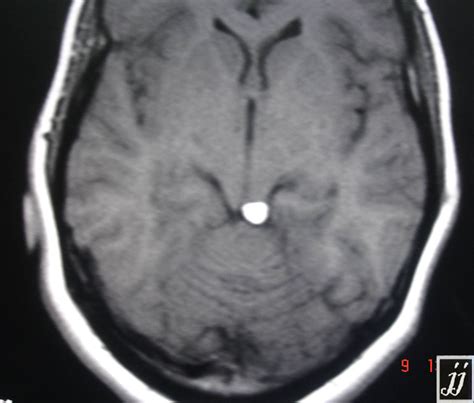 Lipoma On Quadrigeminal Cistern Radiopaedia