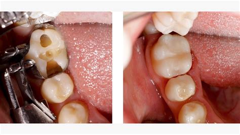 How Do Composite Fillings Work Ilana Ponce