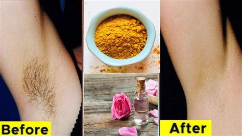 How To Remove Unwanted Hair Permanently At Home