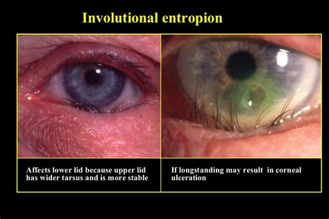 ectropion & entropion