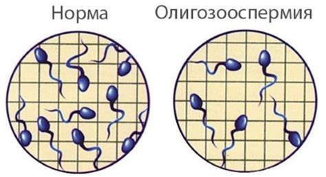 Патологии на главата на сперматозоидите, аспермия, дефекти и ...