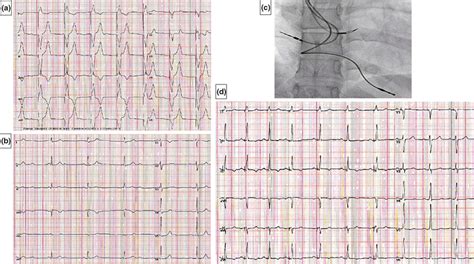 Case 1 Panel A 12‐lead Ecg Showing Rv Pacing In Ddd Mode Panel B Download Scientific