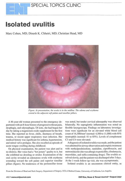 Uvulitis Explained Whats Causing Your Swollen Uvula 47 Off