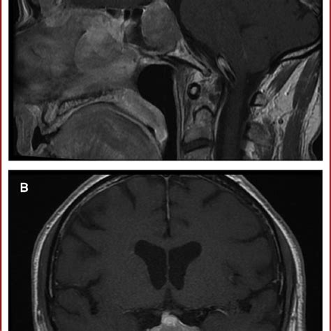 Magnetic Resonance Imaging Scans Of The Sellar Region At Presentation