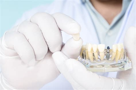 A Comprehensive Guide To Implant Supported Dentures