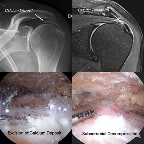 Calcific Tendonitis Sydney Shoulder Unit