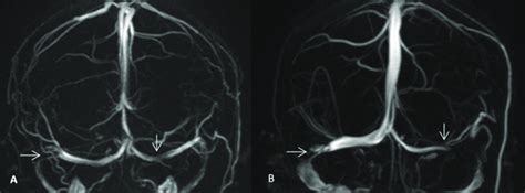 Tss On Mrv A And B Showed Narrowing In Bilateral Transverse Sinus