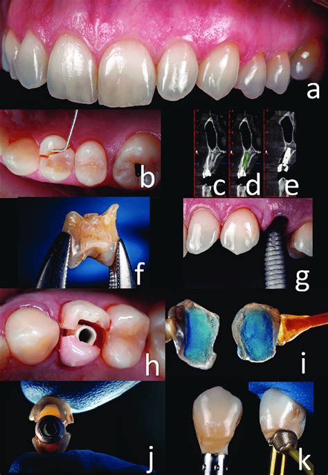 A Buccal View First Premolar Broken B Initial Intraoral Situation