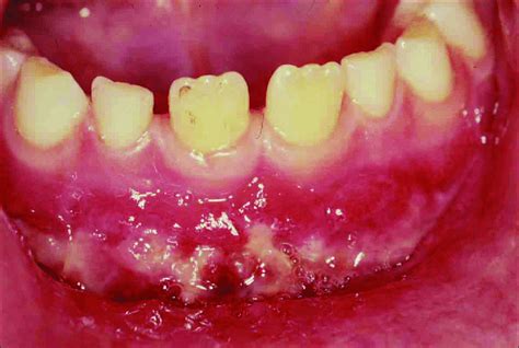 At 1 Week Follow Up After Removal Of Sutures The Alveolar Mucosa