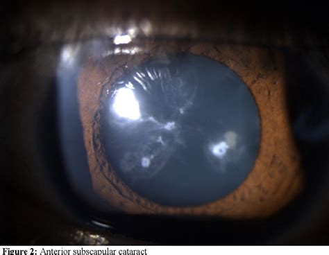 Figure 1 From Anterior Subcapsular Cataract Secondary To Black Mold