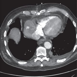 Spontaneous Closure Of Pseudoaneurysm A During Left Heart