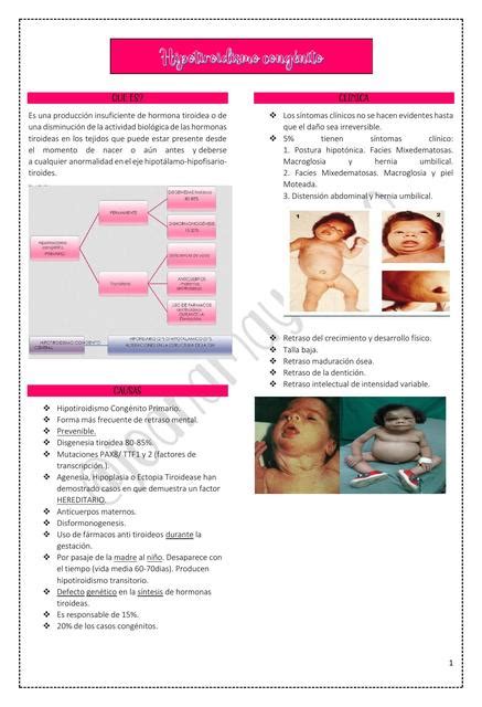 Hipotiroidismo congénito Joana Mayara Eustaquio De Oliveira uDocz