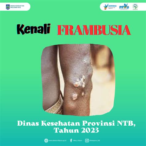 Kenali Frambusia Dinas Kesehatan Provinsi Ntb