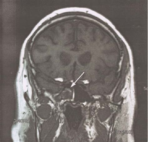 [diagram] Diagram Of Sphenoid Sinuses Mydiagram Online