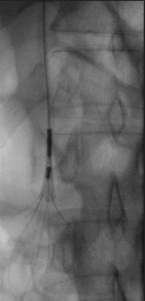 Successful Endovascular Retrieval Of An Aln Inferior Vena Cava Filter