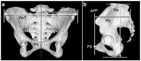 Definitions Of The Pelvic Parameters Used In This Study Pelvic Width