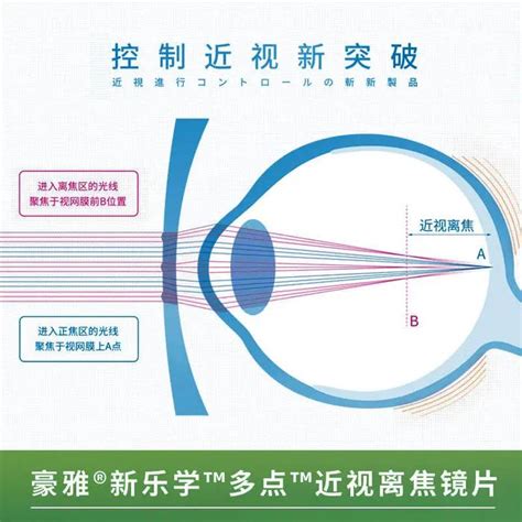 多点近视离焦镜片预防近视的优缺点框架ok镜度数新浪新闻