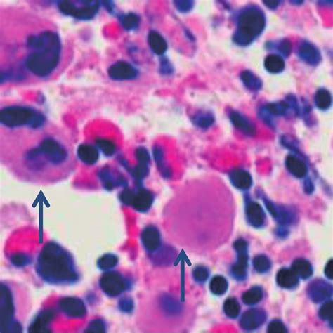 Bone Marrow Biopsy Showing Increased Number Of Megakaryocytes That Are