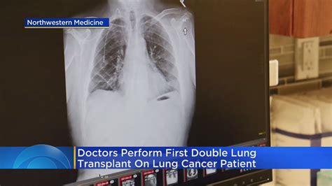 Doctors Perform First Double Lung Transplant On Lung Cancer Patient